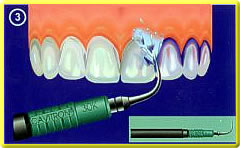 Prophylaxe - Professionelle Zahnreinigung mit Ultraschall