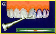Prophylaxe - Professionelle Zahnreinigung mit Handinstrumenten