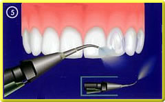 Prophylaxe - Politur der Zähne mit Pulverstrahlgerät