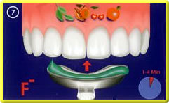 Prophylaxe - Fluoridierung der Zähne
